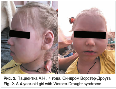 Рис. 2. Пациентка А.Н., 4 года. Синдром Ворстер-Дроута Fig. 2. A 4-year-old girl with Worster-Drought syndrome