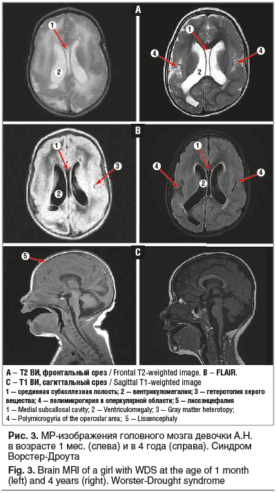 Рис. 3. МР-изображения головного мозга девочки А.Н. в возрасте 1 мес. (слева) и в 4 года (справа). Синдром Ворстер-Дроута Fig. 3. Brain MRI of a girl with WDS at the age of 1 month (left) and 4 years (right). Worster-Drought syndrome