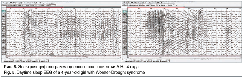 Рис. 5. Электроэнцефалограмма дневного сна пациентки А.Н., 4 года Fig. 5. Daytime sleep EEG of a 4-year-old girl with Worster-Drought syndrome