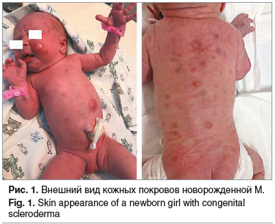 Рис. 1. Внешний вид кожных покровов новорожденной М. Fig. 1. Skin appearance of a newborn girl with congenital scleroderma